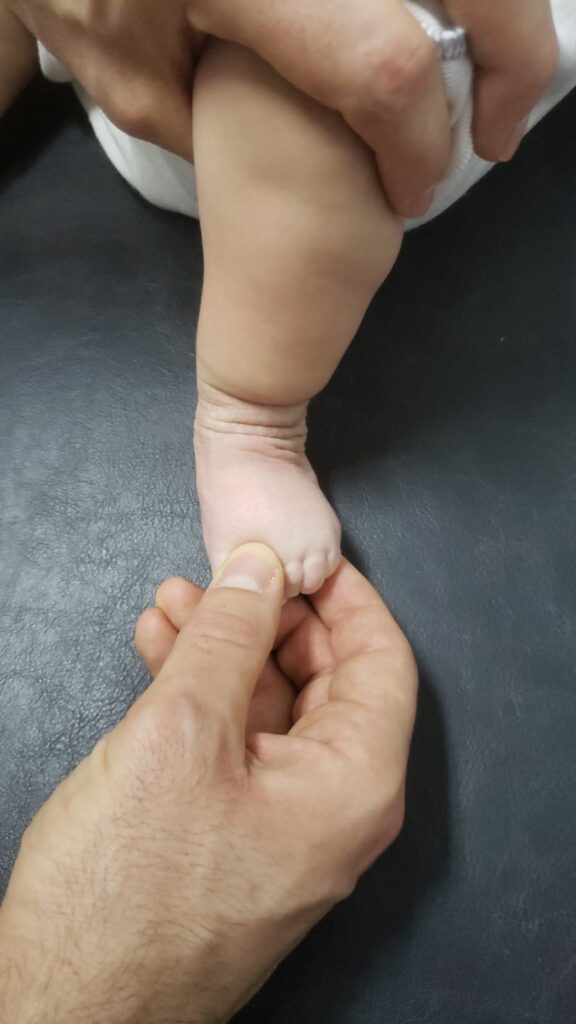 Gael. Pie bot, 3 meses luego de su cirugía