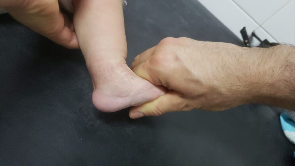 Gael. Pie bot, 3 meses luego de su cirugía