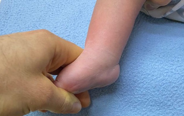 Gael. Pie bot, antes de su cirugía