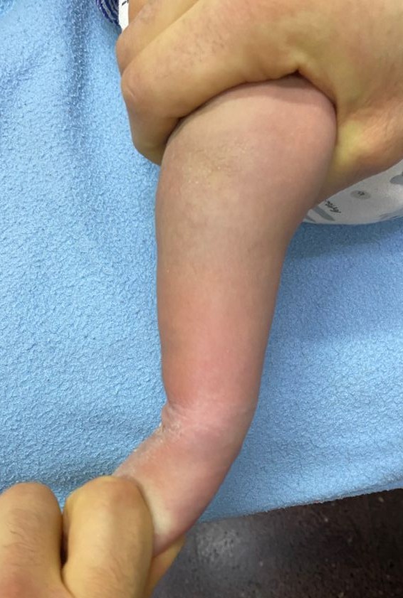 Gael. Pie bot, antes de su cirugía