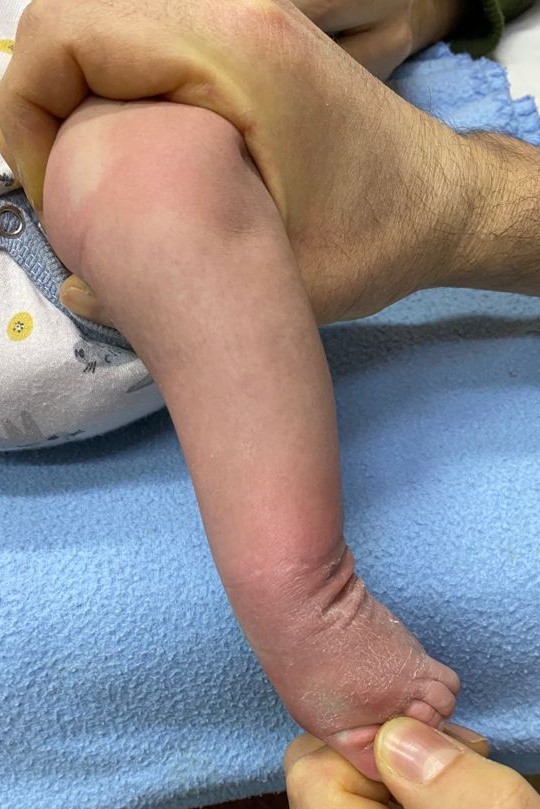 Gael. Pie bot, antes de su cirugía