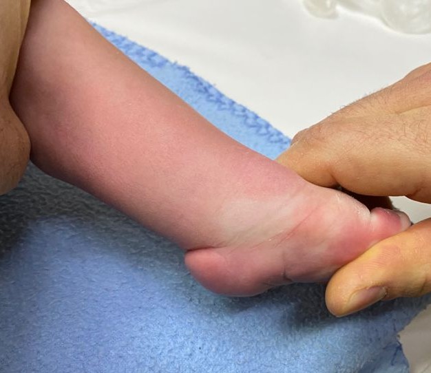 Gael. Pie bot, antes de su cirugía