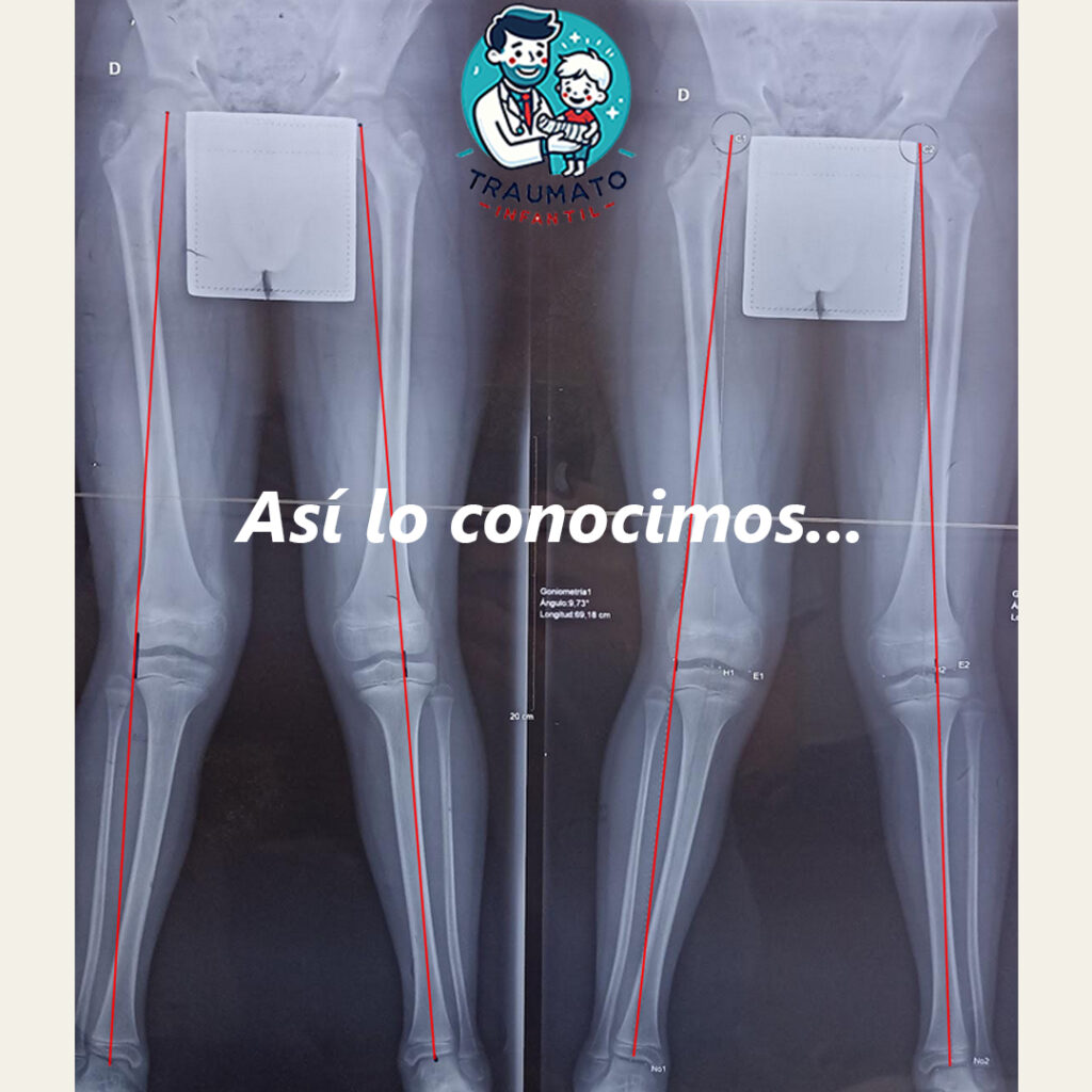 Genu valgo infantil tratamiento