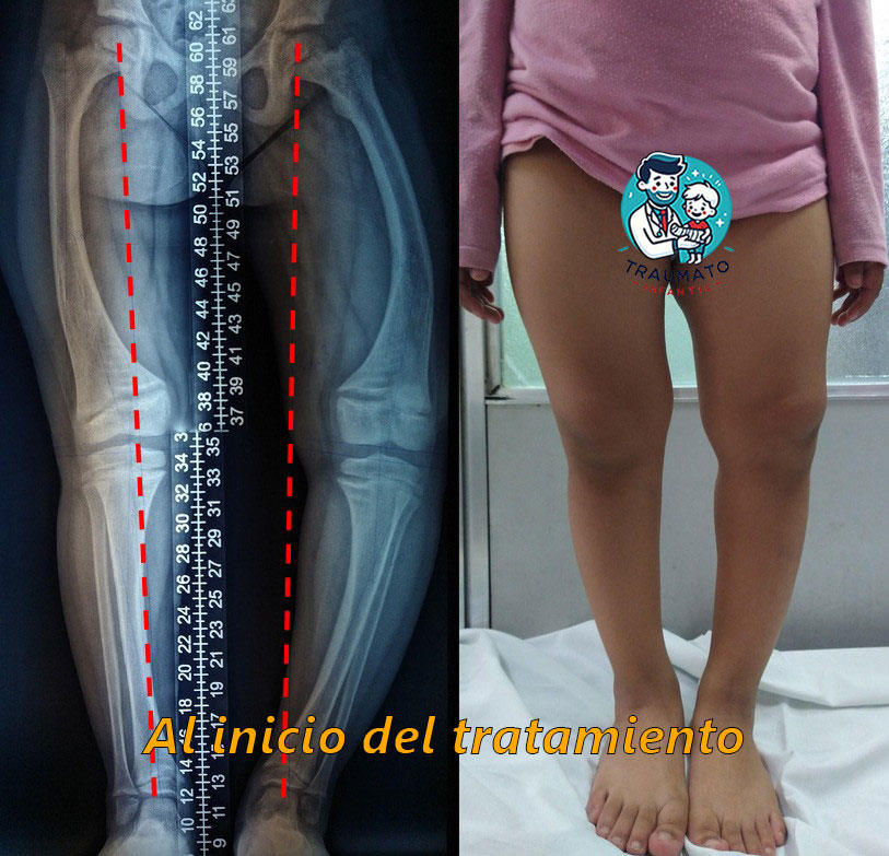 Raquitismo infantil prequirurgico