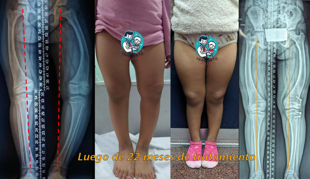 Raquitismo infantil posquirurgico