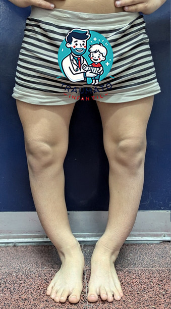 Raquitismo hipofosfatémico